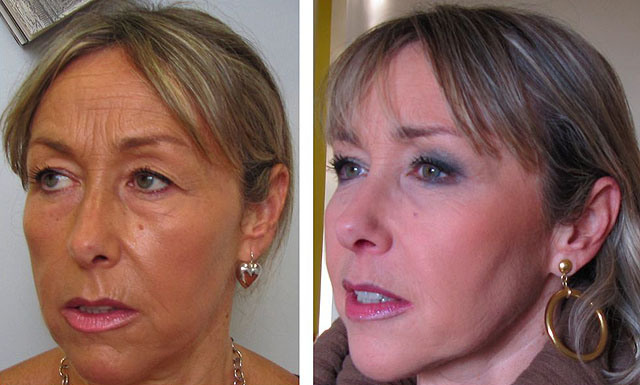 Фото до и после липофилинга щек и скул