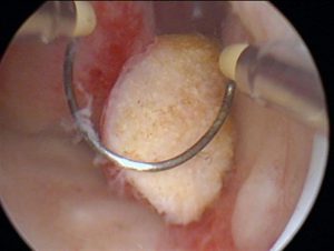 Цена операций по удалению полипа маточной полости