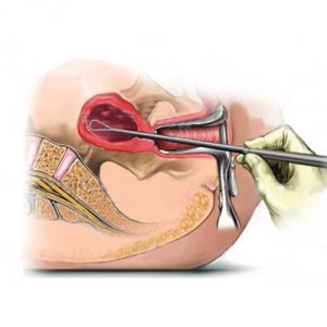 Выскабливание тела матки при полипозе