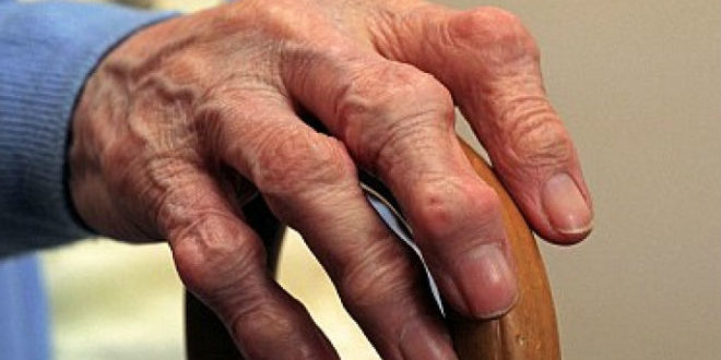 Деформирующий остеоартроз