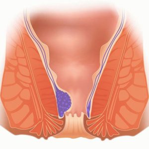 Причины острого геморроя