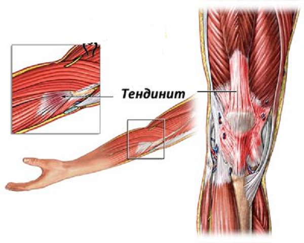 тендинит